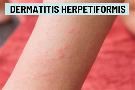 Itchy Bumps on Skin: 21 Causes, Pictures, and Treatment