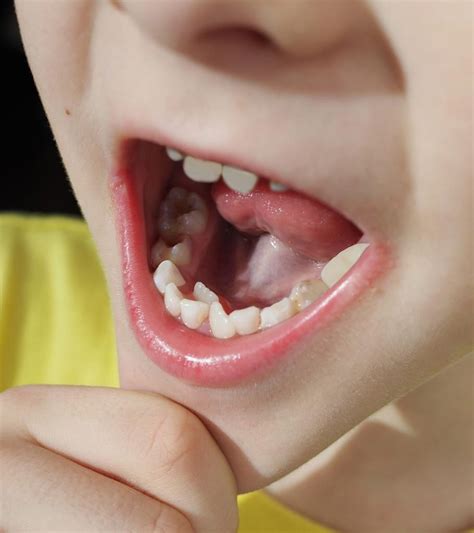 What is hyperdontia? Click to learn more about this condition.