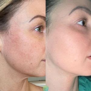 checmical-peel-before-and-after-img-6 | Novique Medical Aesthetics