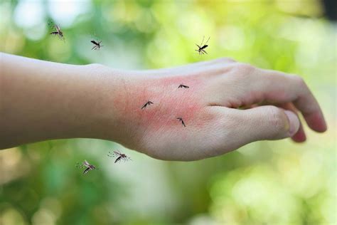 Mosquito Bite Pictures