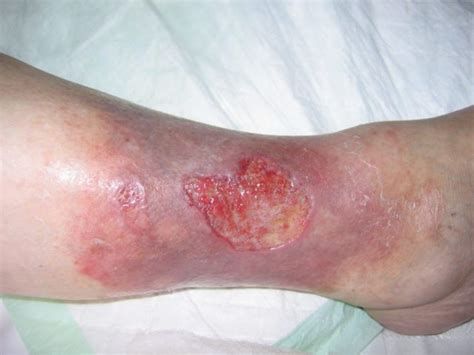 venous leg ulcer urgo healthcare professionals