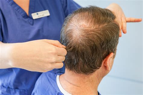 Maximising a Patients Donor Hair for Transplantation - Hair Transplant ...
