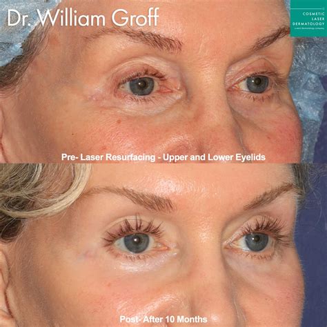 takeeyes  surgical eye rejuvenation cosmetic laser dermatology