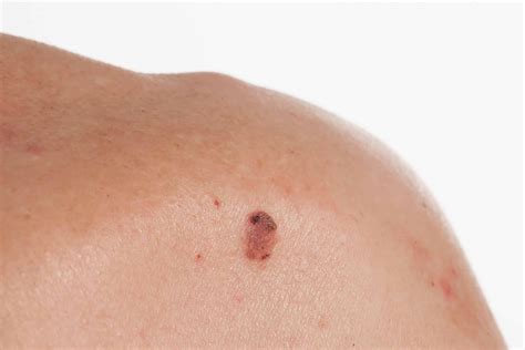 Squamous Cell Carcinoma - Excision - Prognosis - TeachMeSurgery