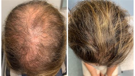 Unveiling the Power of DHT Blockers: Combatting Hair Loss with
