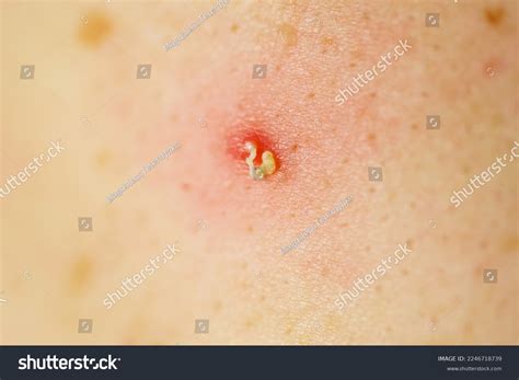 How To Burst A Big Pimple at Marisa Randolph blog