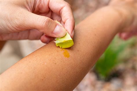 Pode Passar Babosa Em Queimadura - Babosa no Tratamento de Queimaduras: Benefícios e Como Usar - Vuelo Pharma