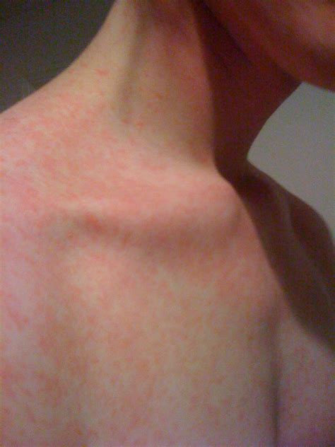 Medicine for health care: Hives (urticaria)