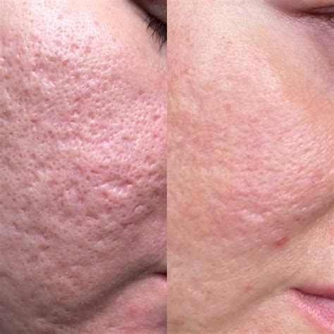 Tipos de Cicatrices de Acné: ¿Cómo Identificarlas y Tratarlas? | RegenElit