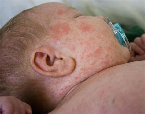 Mancha Vermelha Em Bebe - Manchas vermelhas no bebê: o que pode ser (e como tratar) - Tua Saúde