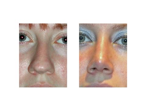 Rhinoplasty and Health Insurance - How To Avoid Paying Through The Nose