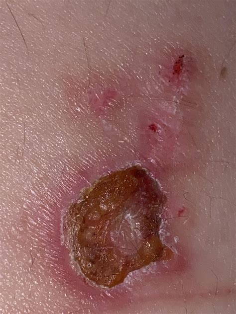 Is this burn healing properly? : r/firstaid