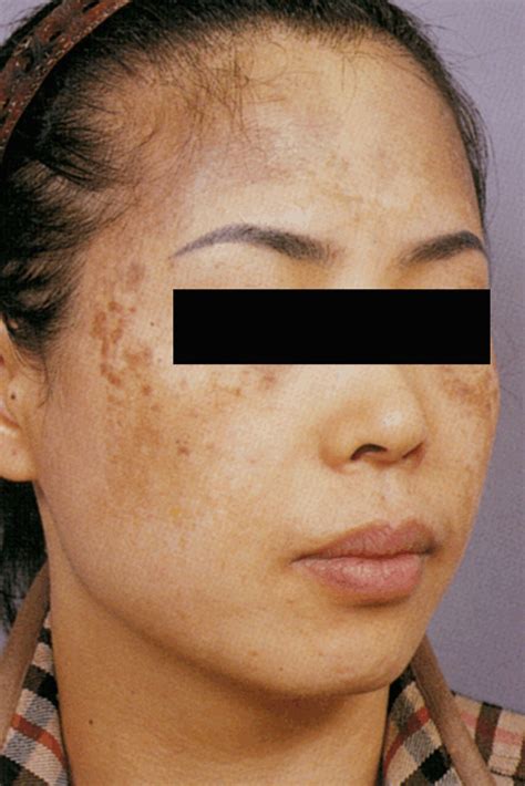 skin hyperpigmentation