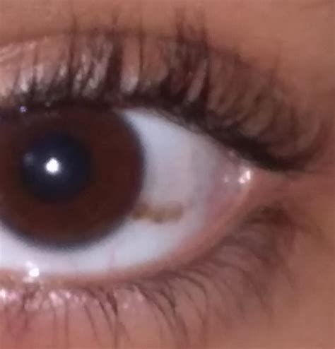 popped blood vessel on face 9