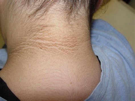 What Causes Acanthosis Nigricans? 13 Possible Causes You Should Know ...