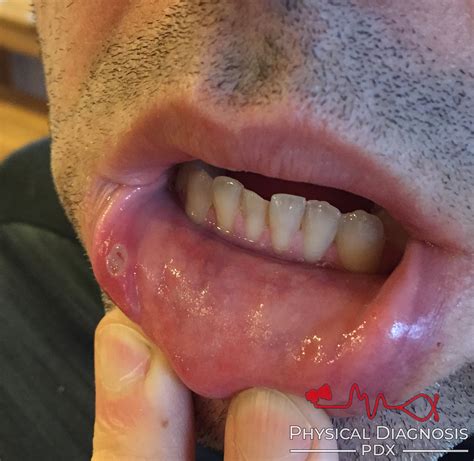 Oral Ulcers - Physical Diagnosis PDX