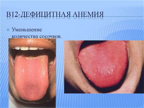 Дифференциальная диагностика анемий - презентация онлайн