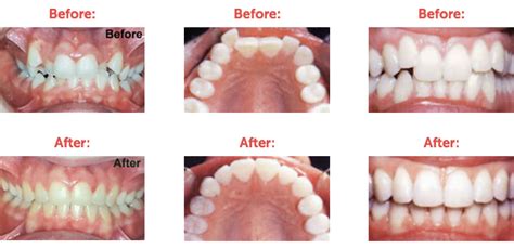 crowding teeth
