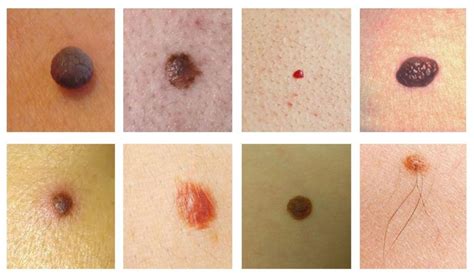 skin moles types