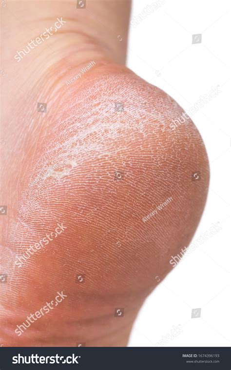woman cracked feet images stock  vectors shutterstock
