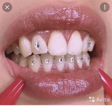 Скайсы | Diamond teeth, Teeth jewelry, Tooth gem