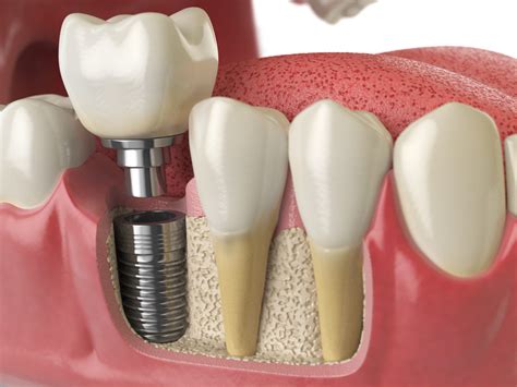Discover the Benefits of Dental Implants Today