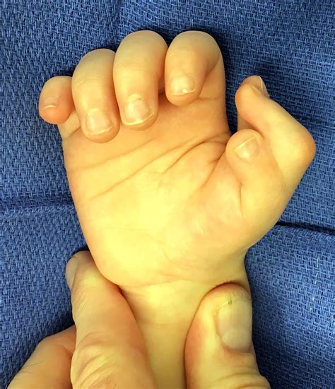 Three thumbs | Congenital Hand and Arm Differences | Washington