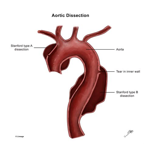 Aortic Dissection - Cardiovascular - Medbullets Step 2/3