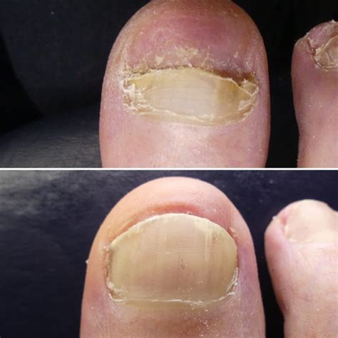 lunula laser  fungal nails infinite podiatry