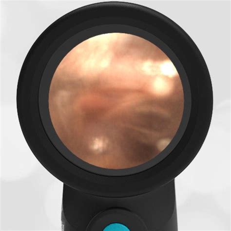 middle ear effusion  cerumen wiscmed