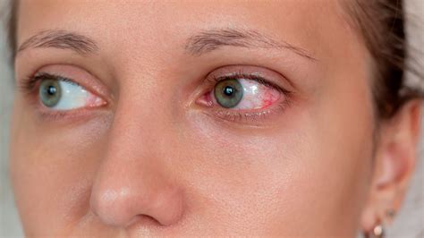 keratitis types  treatment