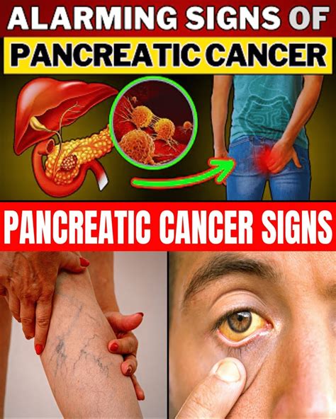 12 Warning Signs of Pancreatic Cancer You’re Likely Ignoring Right Now
