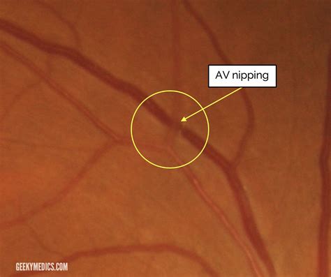 Hypertensive Retinopathy | Malignant Hypertension | Geeky Medics