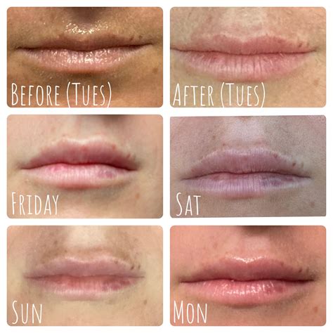 How To Make Lip Filler Swelling Go Down Quicker at Martha Ehrlich blog
