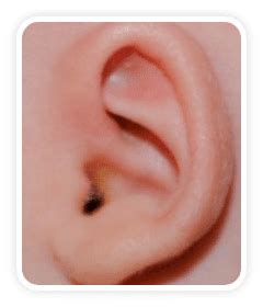 infantear talexmedical llc malvern