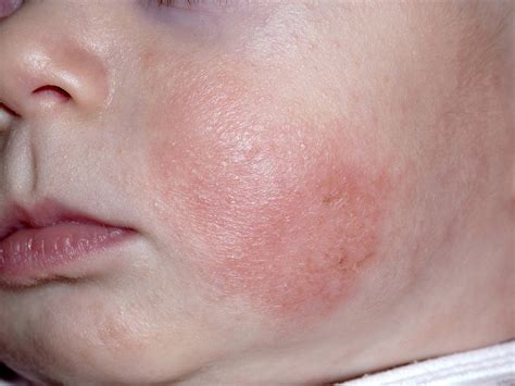 Feridas Na Cabeça Do Bebê De 2 Anos - Caspa e casquinhas na cabeça do bebê (crosta láctea) | BabyCenter