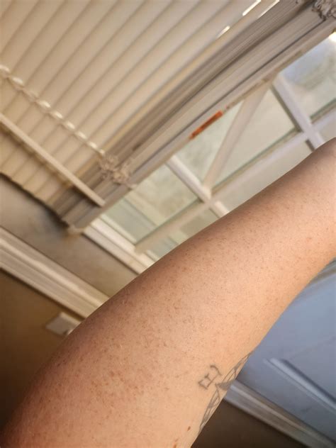 Tazorac update : r/keratosis
