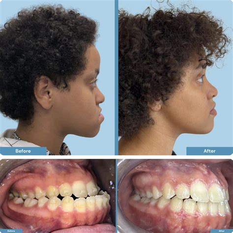 orthognathic jaw surgery     eldon berthold blog