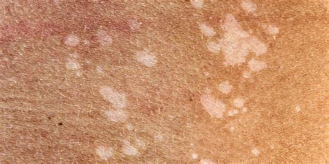 white patch  skin    concern artofit