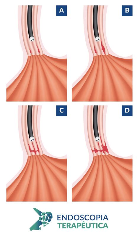 Grau A De Los Angeles - Esofagite erosiva - Los Angeles • Endoscopia Terapeutica