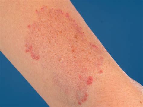Elastosis Perforans Serpiginosa American Society Of Dermatopathology