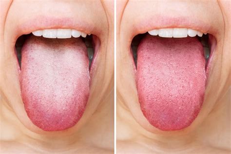 White Tongue Causes 10 Natural Treatments For White T - vrogue.co