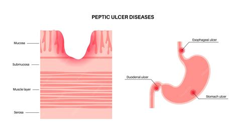 premium vector peptic ulcer disease sore    wall