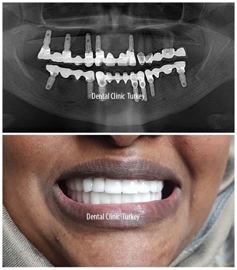 Full Mouth Dental Implants - Full Mouth Reconstruction | Dental Clinic ...
