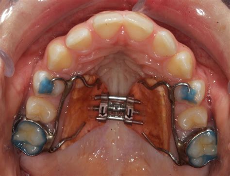 how to know if i need a palate expander