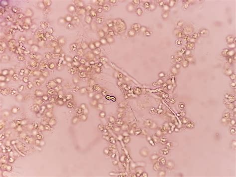 candida  urine  microscope