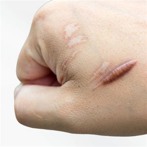 keloid scars info  cosmedics skin clinics