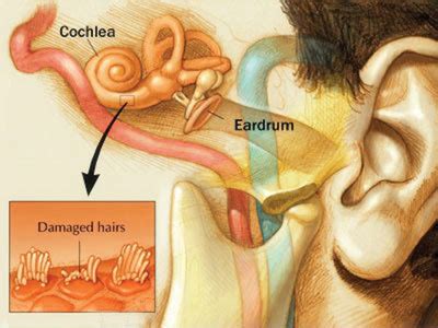 Cochlear Damage and its Effect on Hearing | Life Hearing Solutions