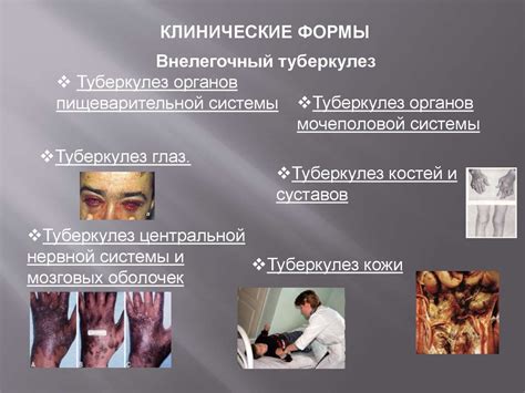 Туберкулез. Возбудитель туберкулеза - презентация онлайн