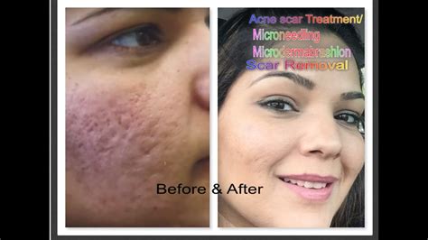 Micro Needling Before And After Acne Scars | Thebrokensealblog